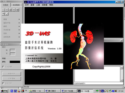 3D-VAS血管手术计算机辅助影像学评估系统